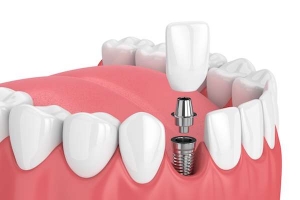 Dental implants: An overview